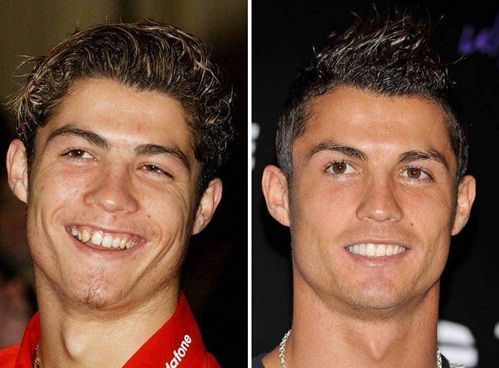 Tabloids have used before/after photos like this one to claim Ronaldo has had plastic surgery