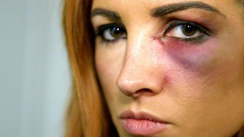 Becky Lynch was eventually unable to compete at Survivor Series but it led to bigger things