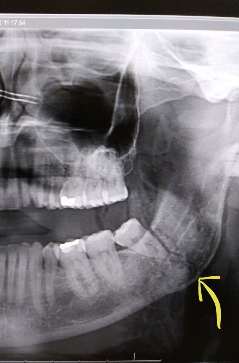 Finn Balor broke his jaw in two places as shown in the X-Ray above.