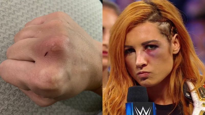 Nia Jax shared a picture of her fist after punching Becky Lynch