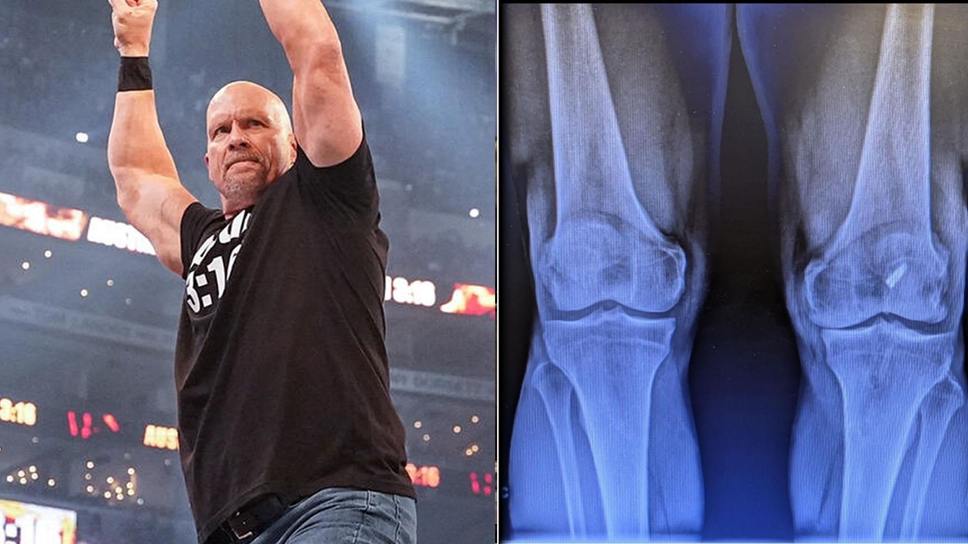 Stone Cold Steve Austin recently had a knee replacement surgery